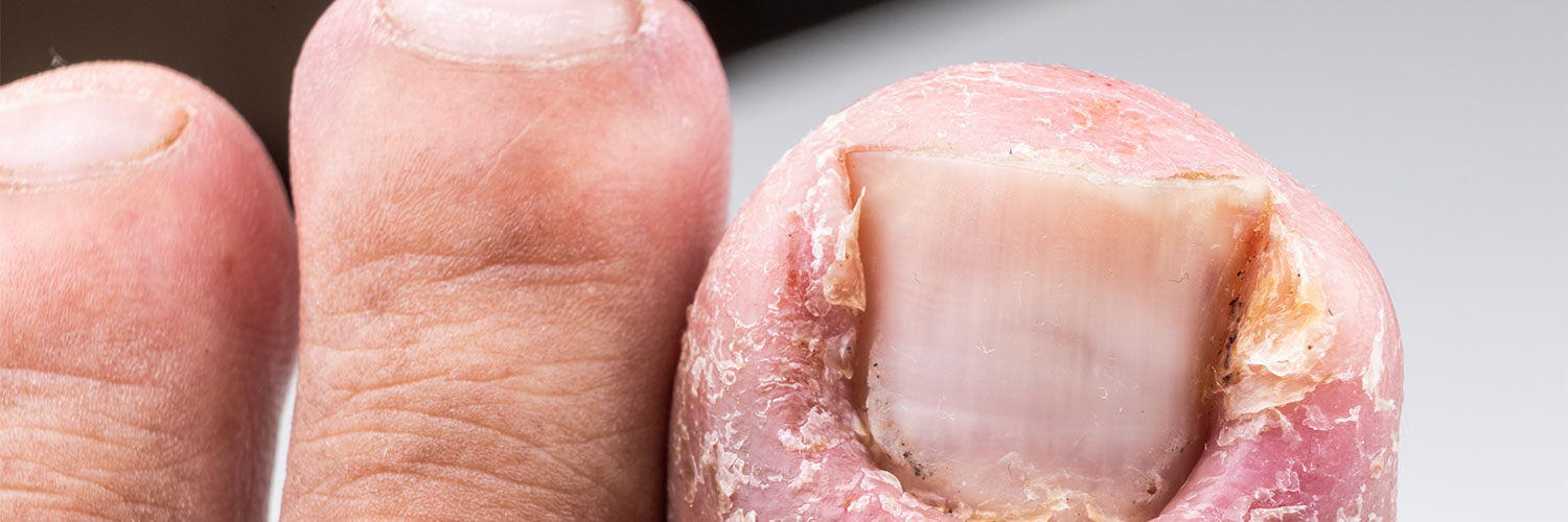 Ingrown toenail non-invasive treatment - The Foot Group