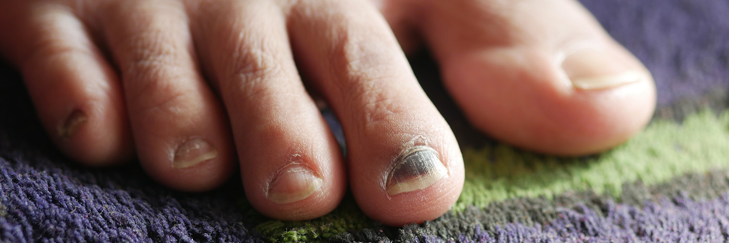 Foot Fungus services